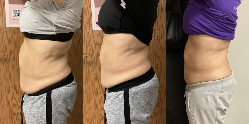 Abdomen sculpting with Emsculpt Neo for muscle toning