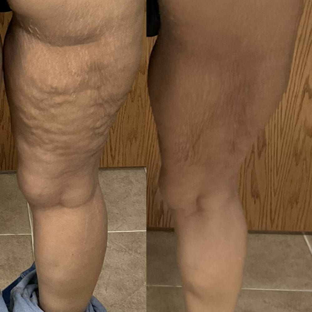 Leg tightening with Emtone and Emsculpt Neo treatment