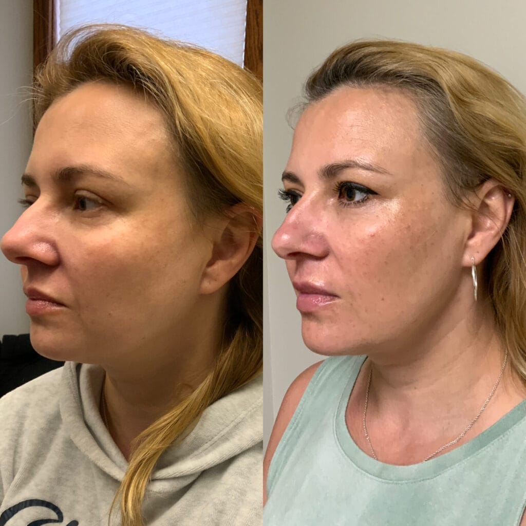 Before and after filler, Botox, and Infini RF laser for facial rejuvenation
