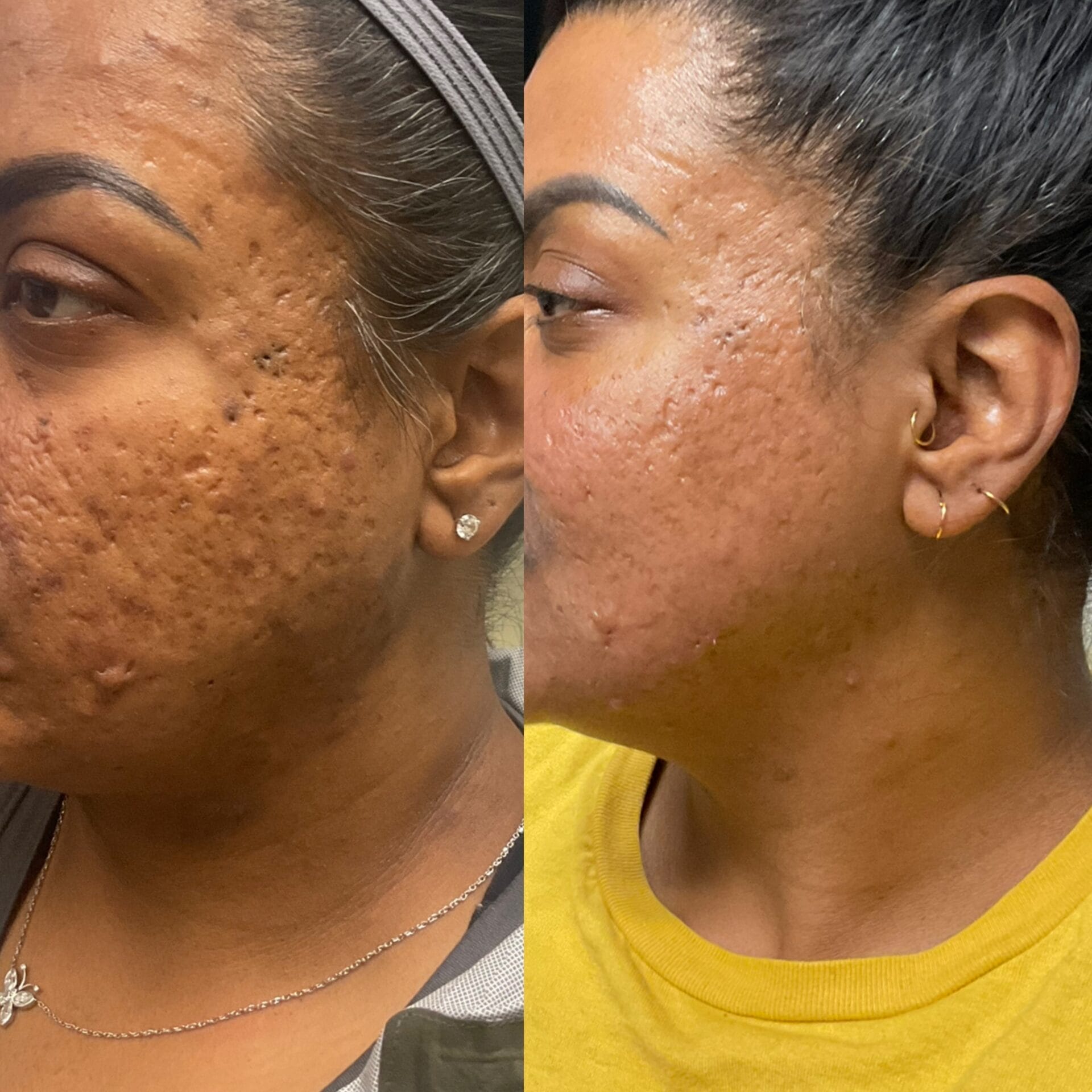 Patient with significant reduction of facial pores after Infini RF Laser Treatment