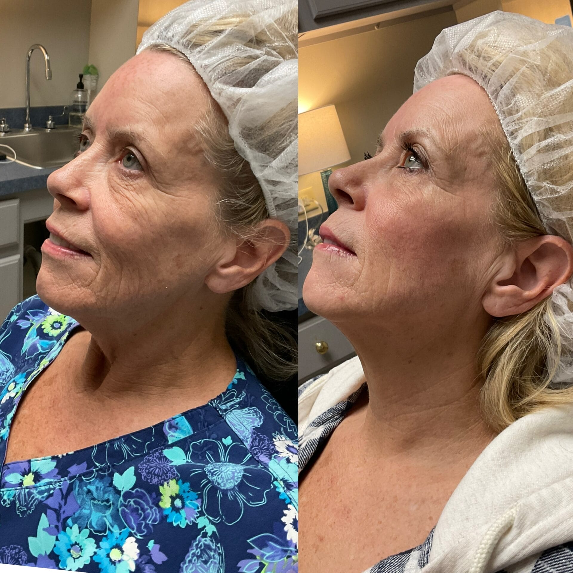 Patient Results from a Combination of LaseMD and Infini RF Lasers