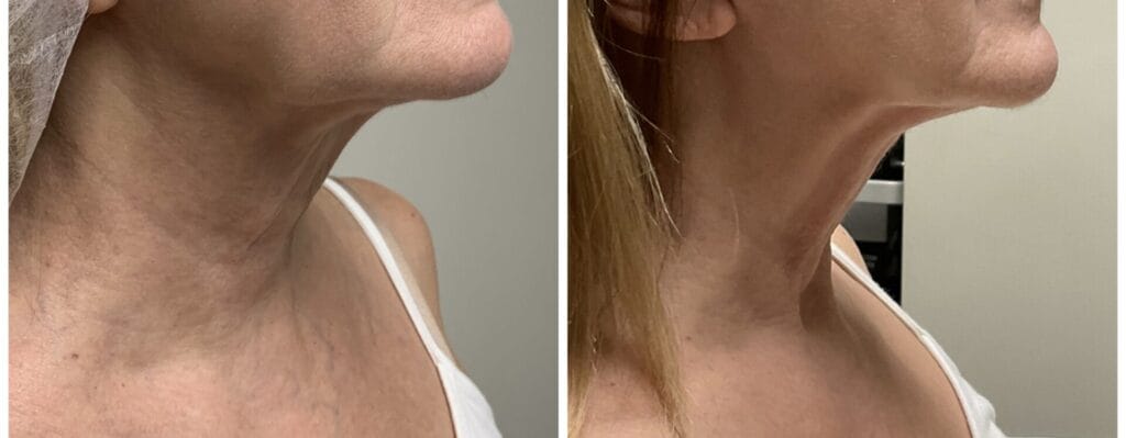 Patient with Tighter Neck After Infini RF Laser Treatment at Dream Med Spa in Plainfield