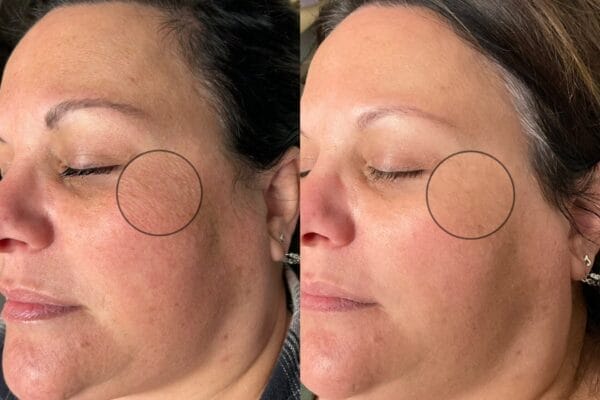 Patient with Tighter Skin on the Face After Recieving LaseMD Laser Treatment