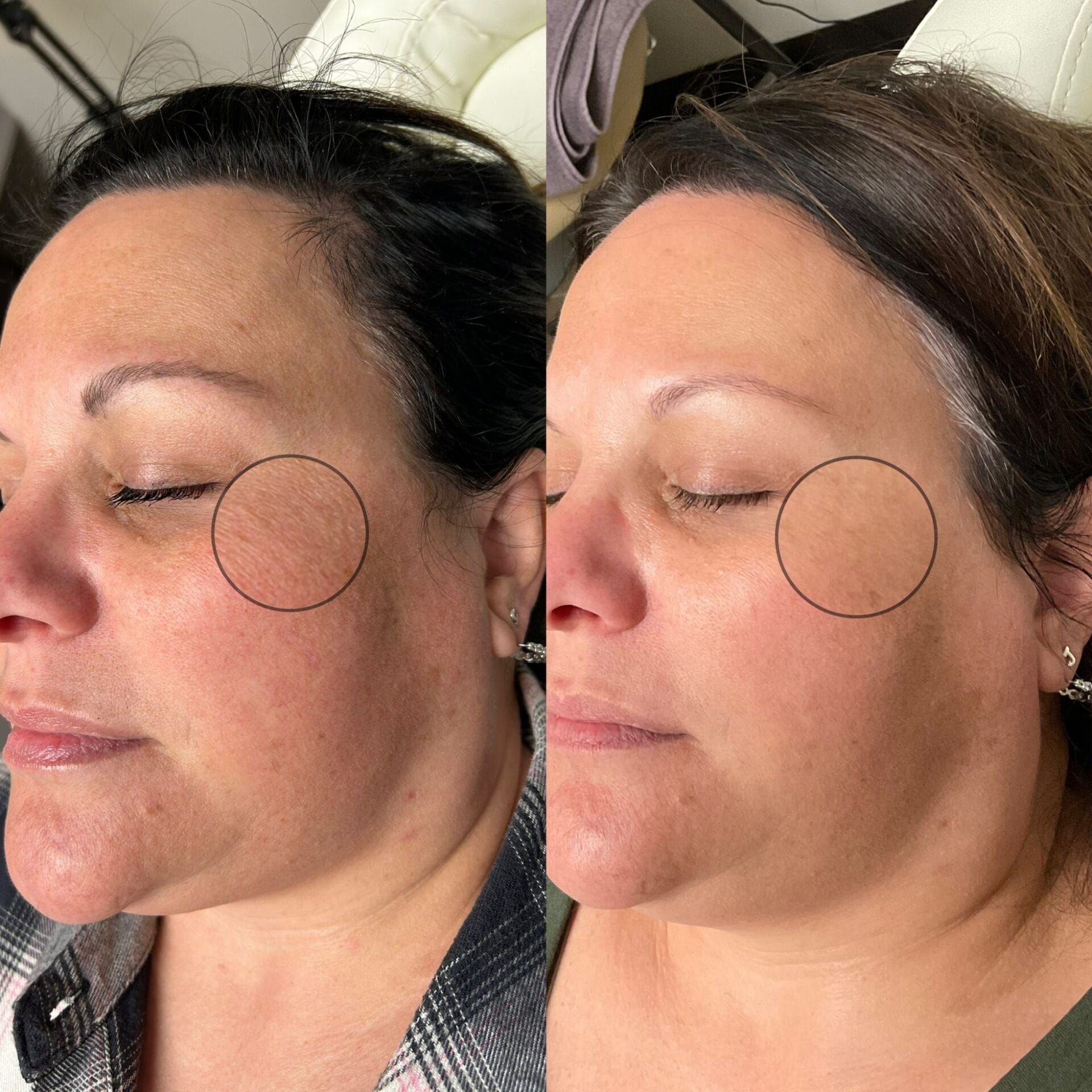 Patient with Tighter Skin on the Face After Recieving LaseMD Laser Treatment