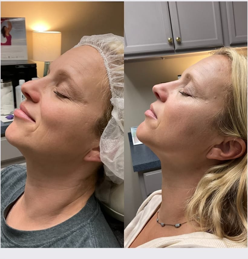 Before and After Patient Photo from LaseMD Laser Treatment