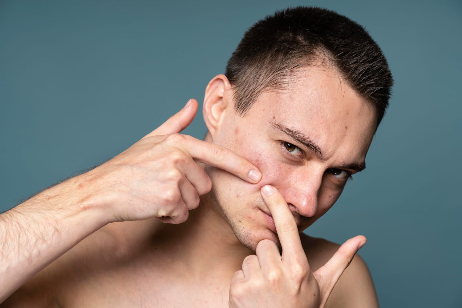 a popped pimple can cause permanent damage such as acne scarring