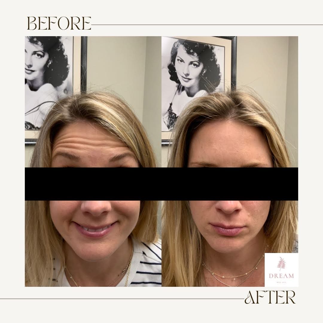 before and after of a middle aged patient getting daxxify treatment for wrinkles