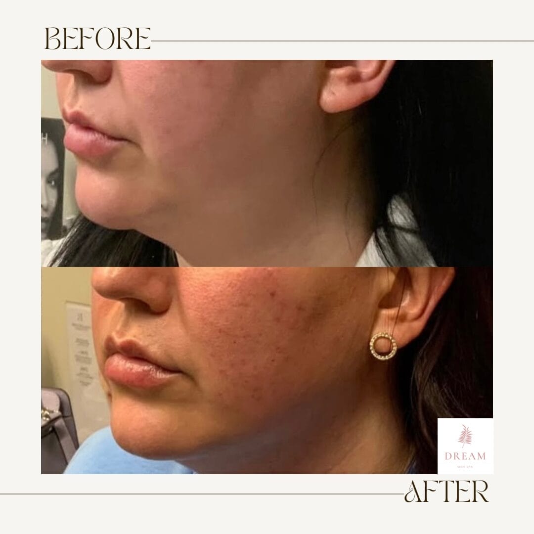 before and after of a patient after getting Square Face Masseter Muscle Correction