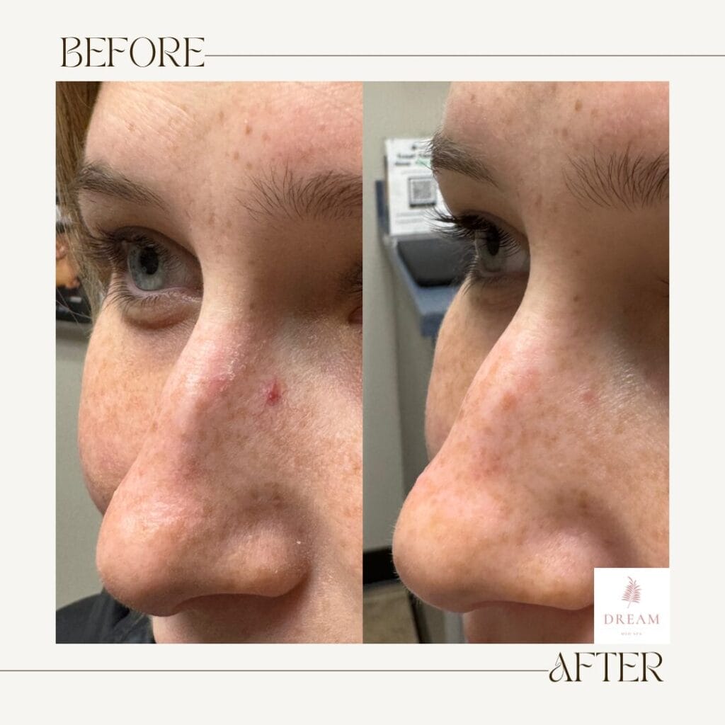 before and after of a patients angiomas after receiving aerolase neo elite laser treatment