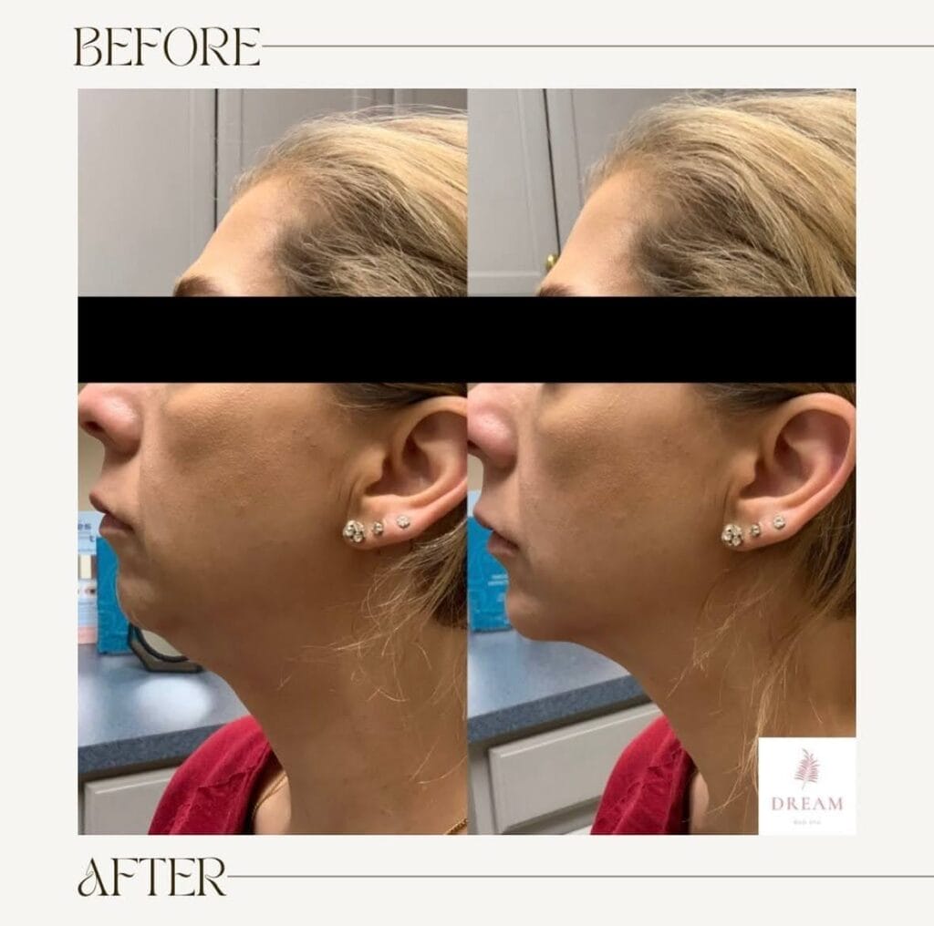before and after of a female patient with jaw contouring procedure