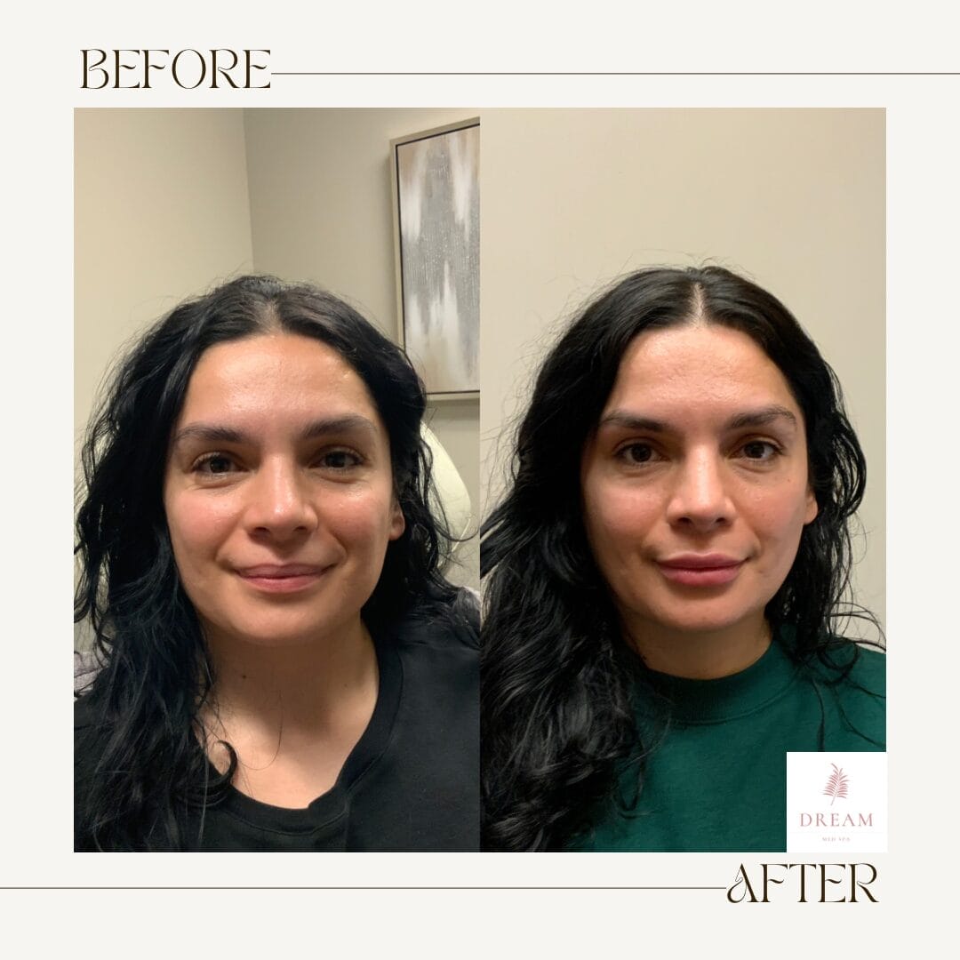 before and after of a patient with lip filler