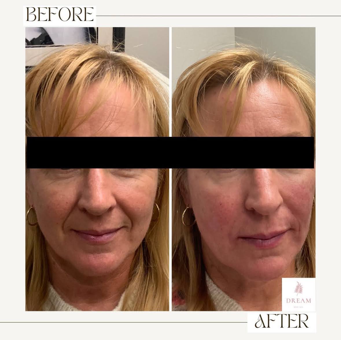 under eye filler near plainfield illinois