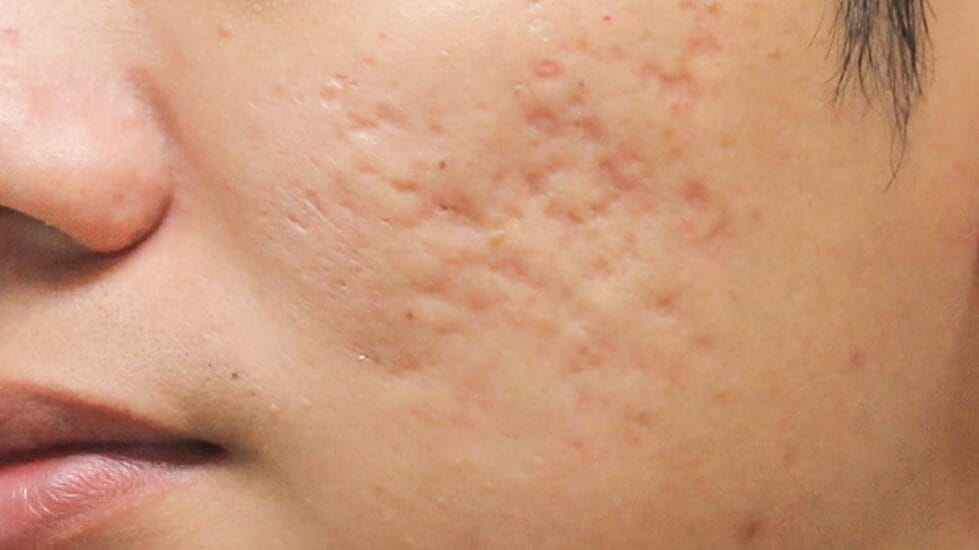 Boxcar acne scars with wide, shallow depressions and sharply defined edges.